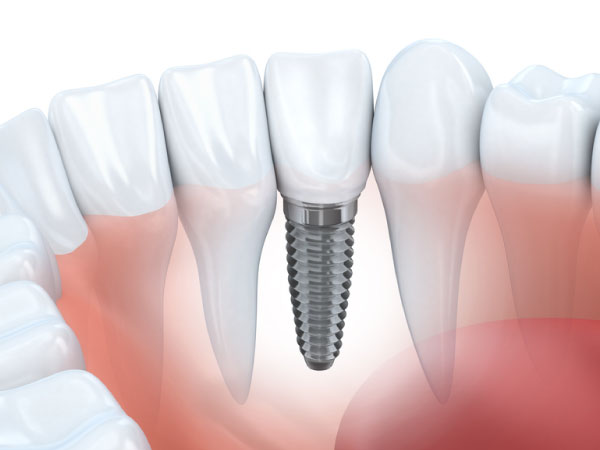 Implantes dentales - Clínica dental Mentrisalud
