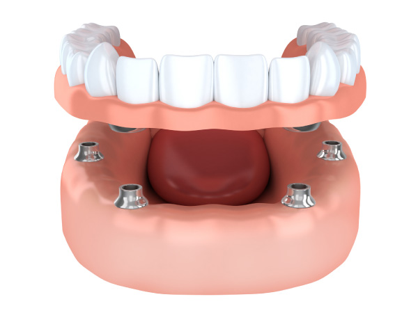 implantes-dentales-interior-arcada-completa-clinica-dental-metrisalud-mentrida